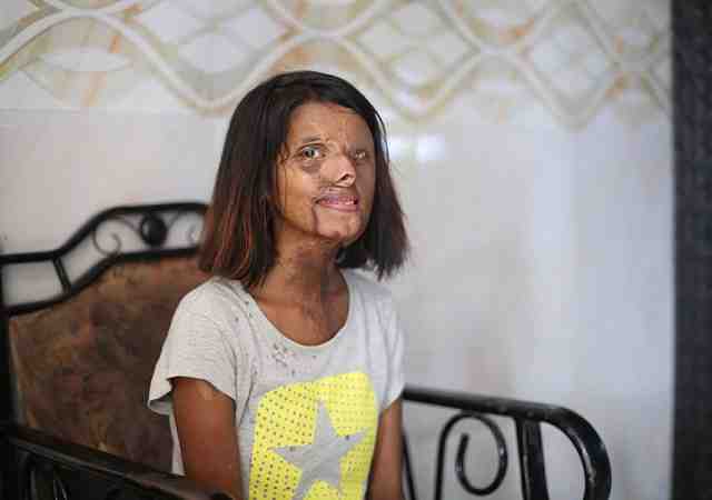23 Year old Acid Attack Survivor Wins our Heart With Her Courage