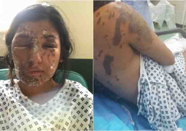 Acid attack victim's recovery pictures will empower you like nothing else