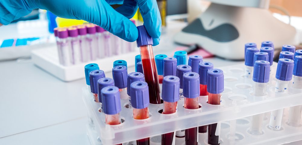 Blood test may detect multiple sclerosis: study