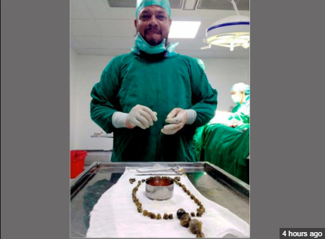 99 stones removed from woman's gallbladder