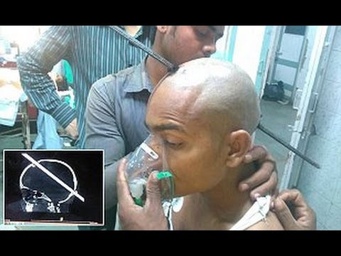Mumbai: 4 ft rod removed from man after 5-hr surgery