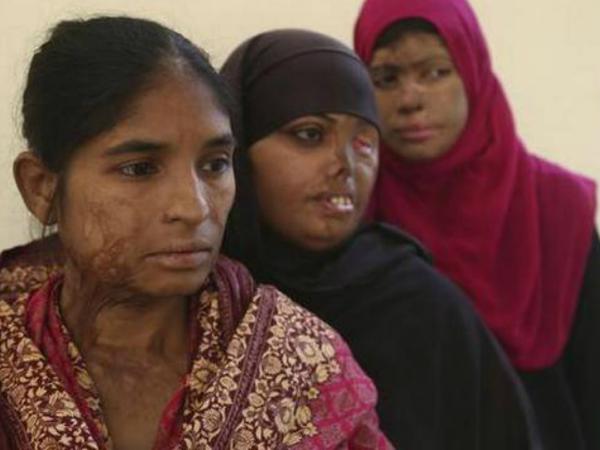 3 Pakistani girls suffer burn injuries as uncle throws acid
