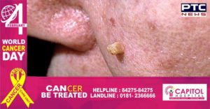 Skin Cancer Symptom and Treatment