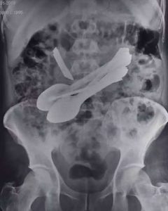 Himachal Pradesh Doctors removed 8 spoons, 2 screwdrivers, 2 toothbrushes and 1 kitchen knife from the stomach man