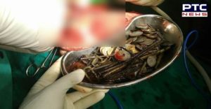 Bengal woman operation During stomach 1.6 kg ornaments, 90 coins, watch removed