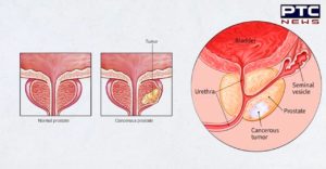 health : What Is Prostate Cancer ? , prostate cancer symptoms and treatment