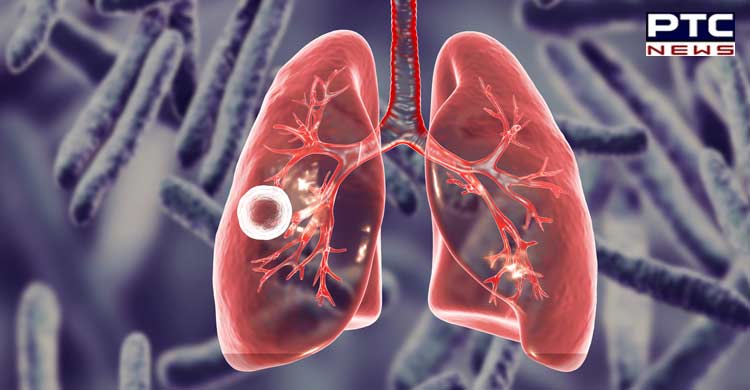 'India-to-be-Tuberculosis-free-by-2025'--3