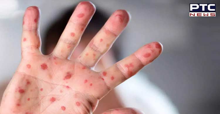 Monkeypox spread across 12 countries, WHO warns, will it spread to India too?
