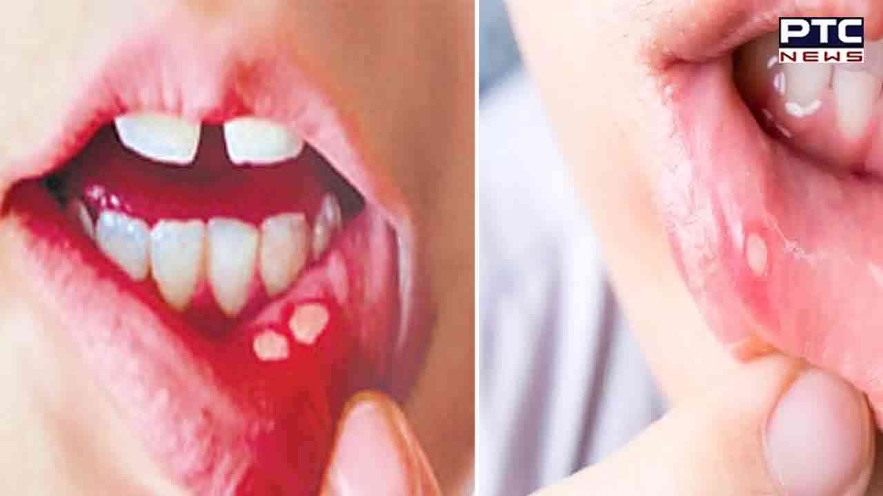 ਮੂੰਹ ਦੇ ਛਾਲਿਆਂ ਤੋਂ ਪ੍ਰੇਸ਼ਾਨ ਤਾਂ ਦਾਦੀ-ਨਾਨੀ ਦੇ ਇਨ੍ਹਾਂ ਘਰੇਲੂ ਨੁਸਖ਼ਿਆਂ ਨਾਲ ਮਿਲੇਗਾ ਤੁਰੰਤ ਆਰਾਮ