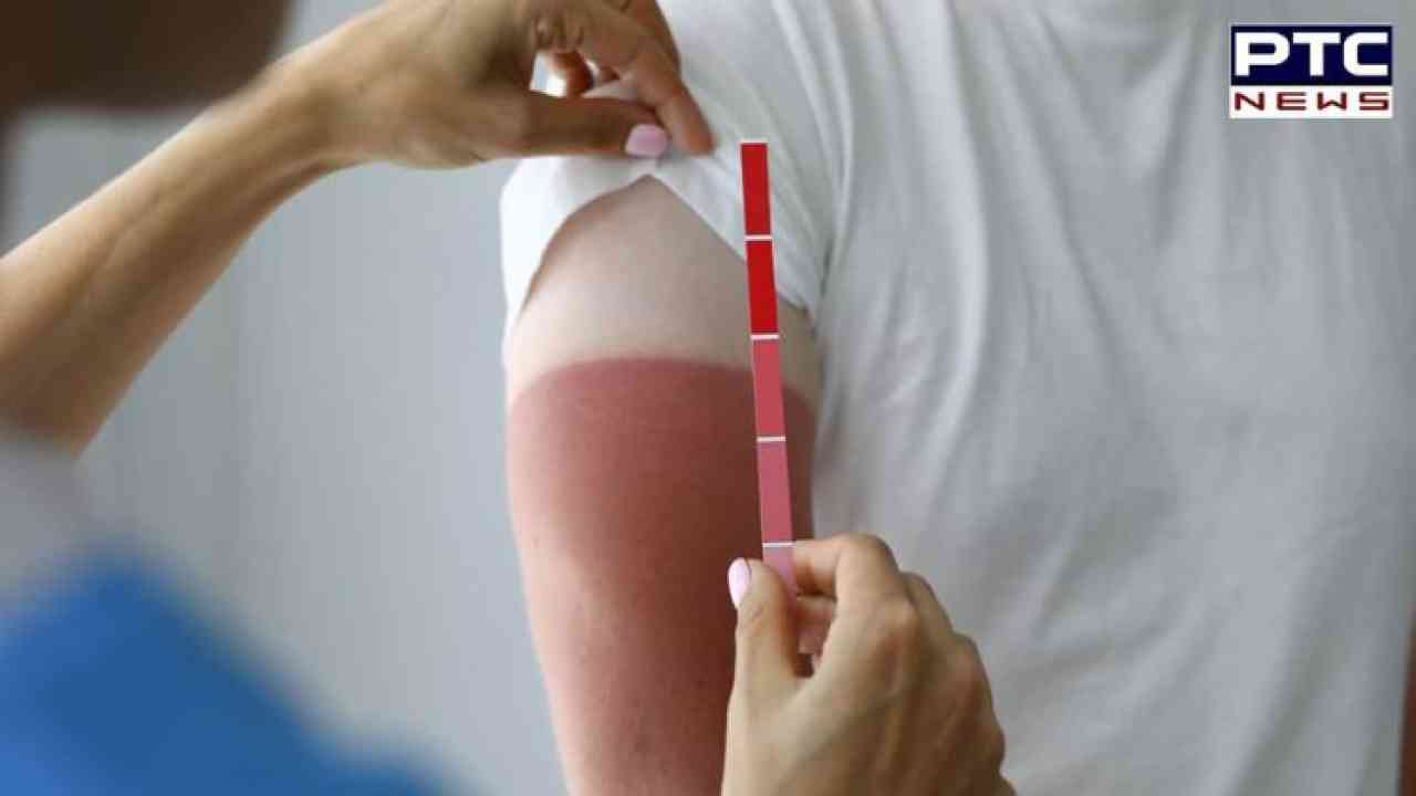 Sun Poisoning: ਬਦਲਦੇ ਮੌਸਮ ਨਾਲ ਵਧੀ 'ਸਨ ਪੁਆਇਜ਼ਨਿੰਗ' ਦੀ ਸਮੱਸਿਆ, ਇਸਦੇ ਬਾਰੇ ...