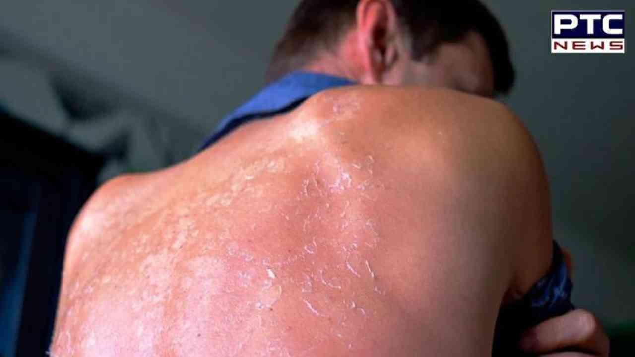 Sun Poisoning: ਬਦਲਦੇ ਮੌਸਮ ਨਾਲ ਵਧੀ 'ਸਨ ਪੁਆਇਜ਼ਨਿੰਗ' ਦੀ ਸਮੱਸਿਆ, ਇਸਦੇ ਬਾਰੇ ...