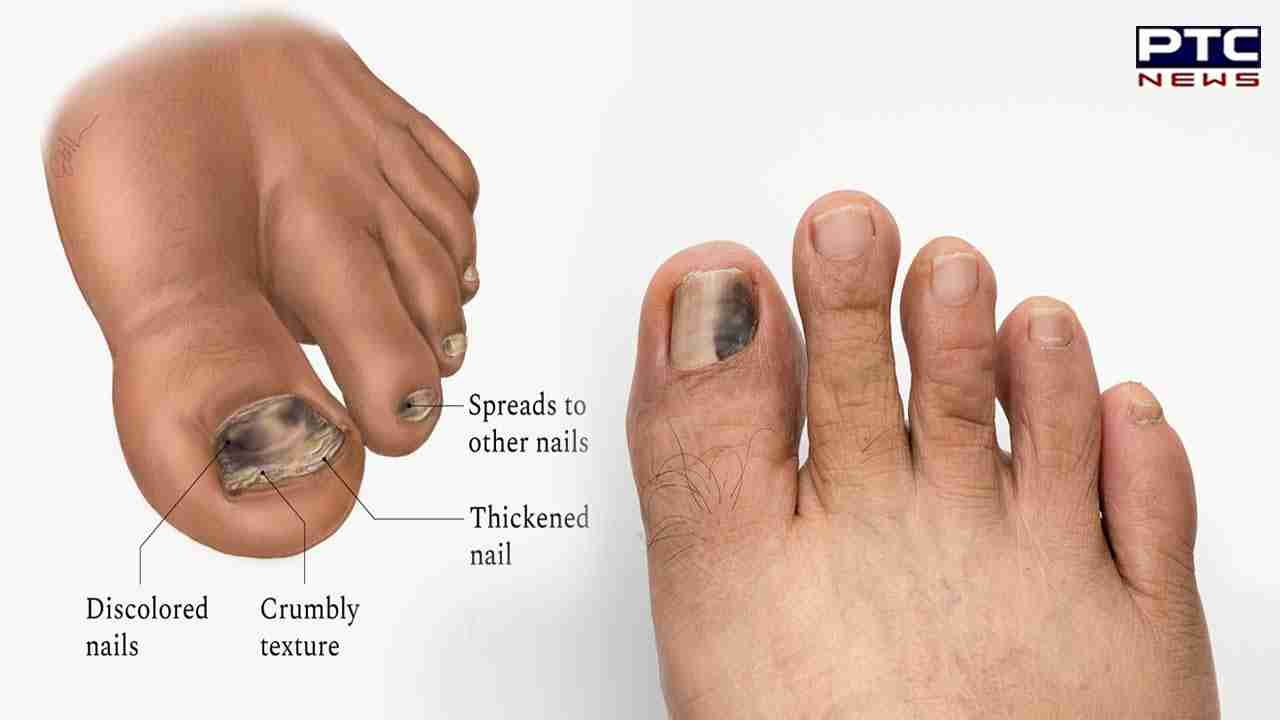 Black Nails Causes : ਪੈਰਾਂ ਦੇ ਕਾਲੇ ਨਹੁੰਆਂ ਤੋਂ ਤੁਸੀਂ ਵੀ ਪਰੇਸ਼ਾਨ ਹੋ, ਤਾਂ ਜਾਣੋ ਇਸਦੇ ਕੀ ਕਾਰਨ ਹੋ ਸਕਦੇ ਹਨ।