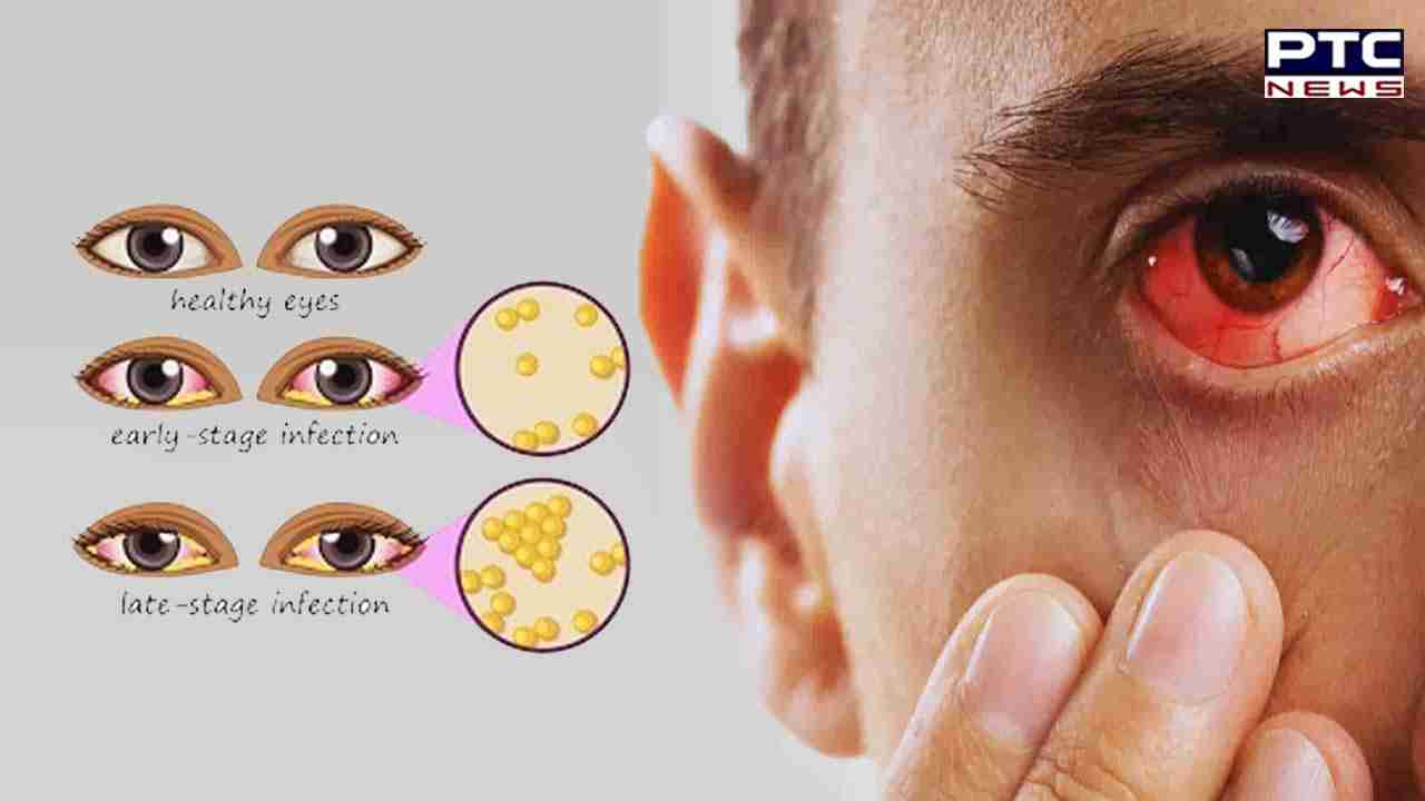 Advisory For Eye Flu: ਮੀਂਹ ਦੇ ਮੌਸਮ ’ਚ ਤੇਜ਼ੀ ਨਾਲ ਫੈਲ ਰਿਹਾ ਅੱਖਾਂ ਦਾ ਫਲੂ, ਇਨ੍ਹਾਂ ਗੱਲ੍ਹਾਂ ਦਾ ਰੱਖਣਾ ਹੈ ਖ਼ਾਸ ਧਿਆਨ
