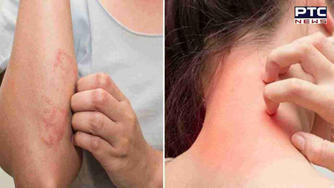Skin Care: ਬਰਸਾਤ ਦੇ ਪਾਣੀ 'ਚ ਭਿੱਜਣ ਨਾਲ ਚਮੜੀ 'ਤੇ ਹੋਣ ਵਾਲੇ ਧੱਫੜ ਅਤੇ ਖਾਰਸ਼ ਦੀ ਸਮੱਸਿਆ ਤੋਂ ਛੁਟਕਾਰਾ ਦਵਾਉਣ 'ਚ ਕਾਰਗਾਰ ਇਹ ਘਰੇਲੂ ਨੁਸਖੇ