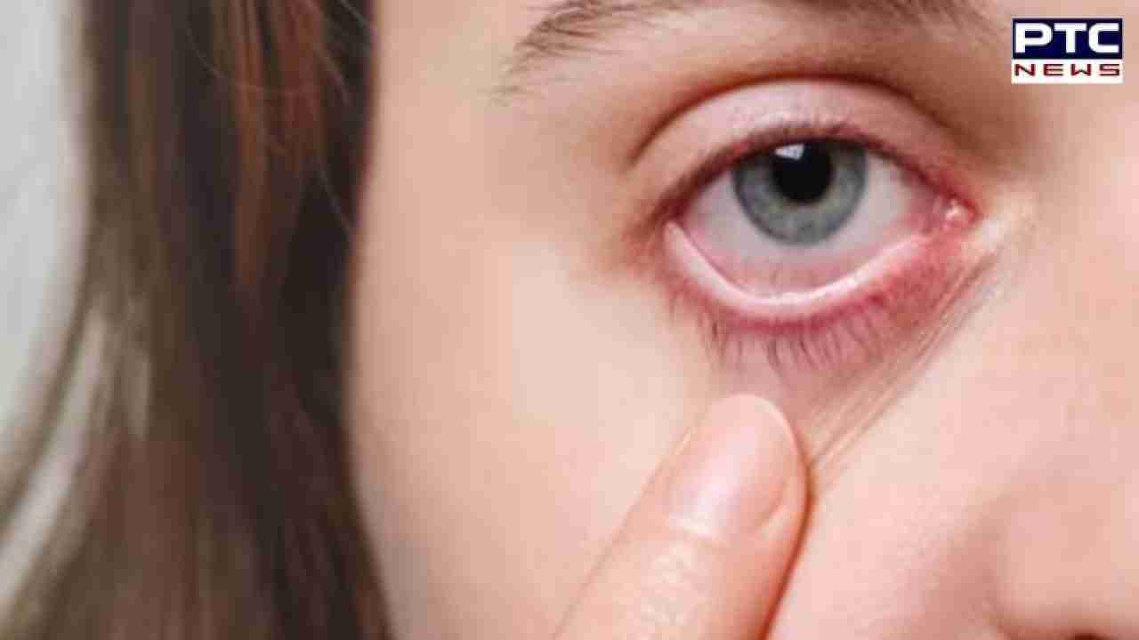 Monsoon Hazard: Delhi-NCR battles alarming surge in daily conjunctivitis cases