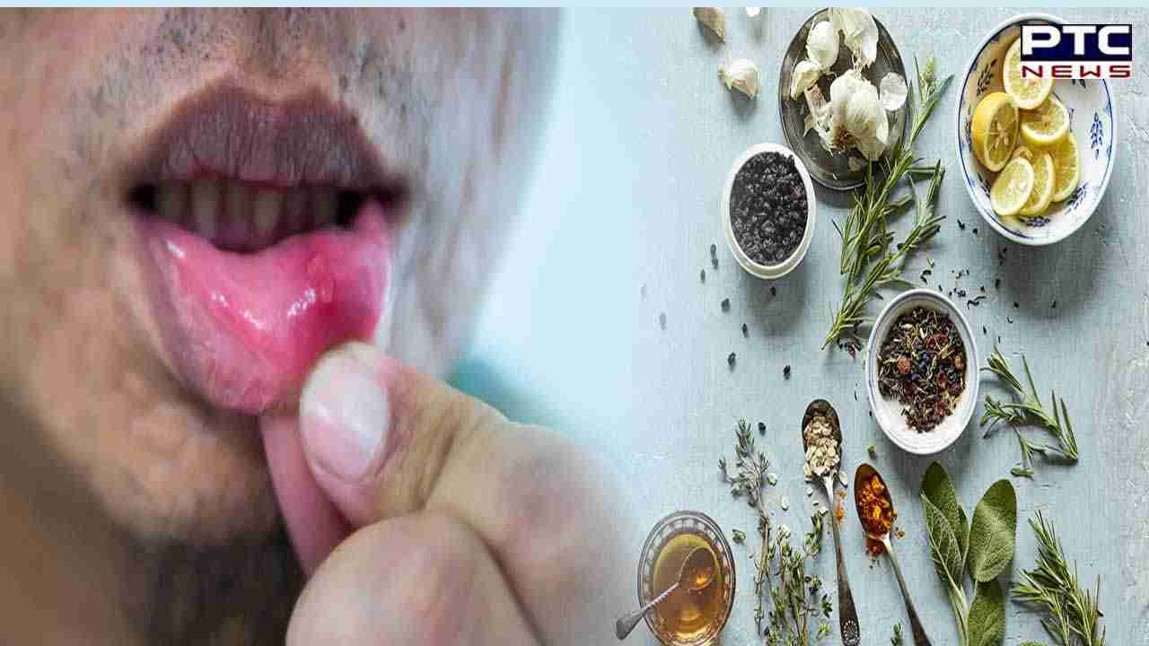 Home Remedies For Tongue Ulcers : ਜੇਕਰ ਤੁਸੀਂ ਵੀ ਜੀਭ ਦੇ ਛਾਲਿਆਂ ਤੋਂ ਹੋ ਪ੍ਰੇਸ਼ਾਨ, ਤਾਂ ਅਪਣਾਓ ਇਹ ਘਰੇਲੂ ਨੁਸਖੇ