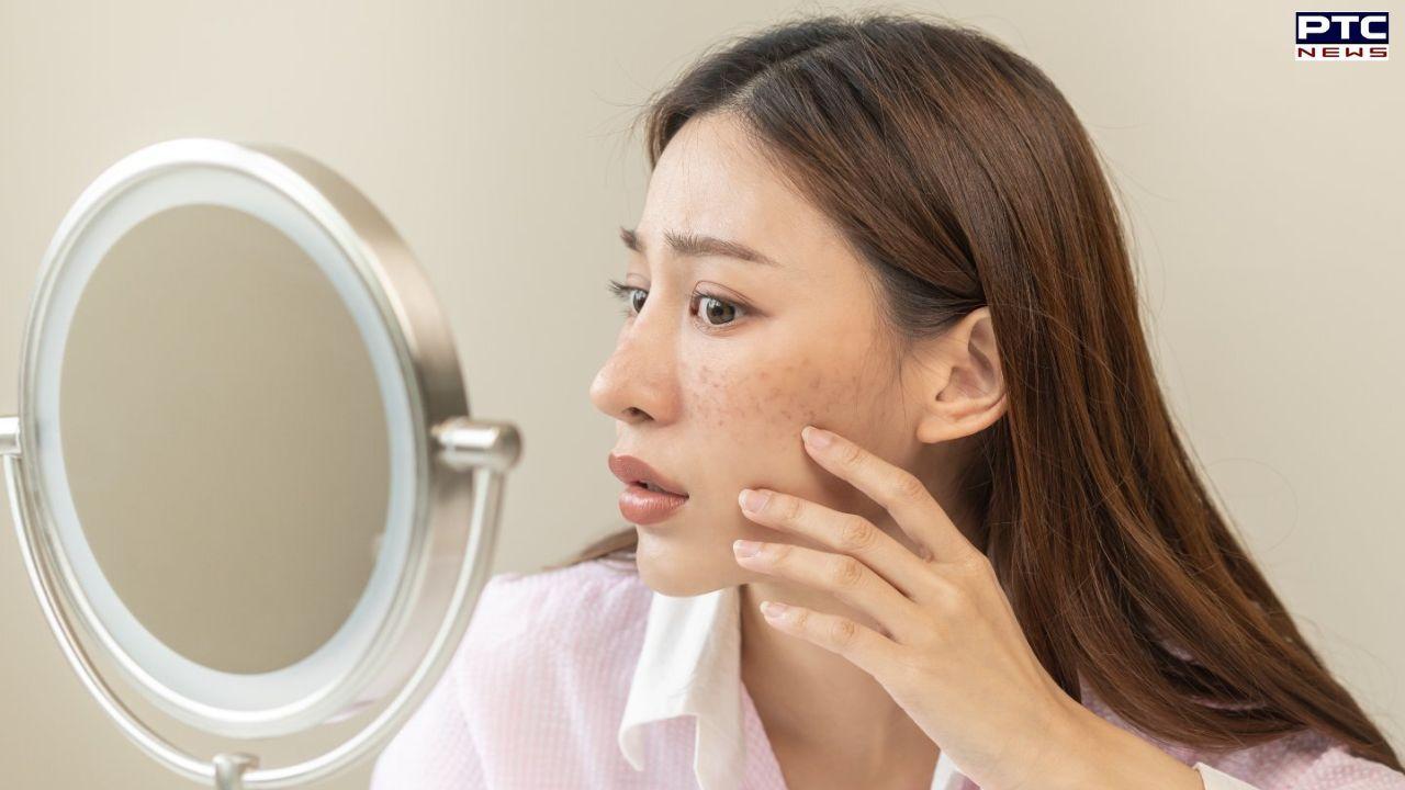 5 Natural Ways To Fade Pimple Scars Web Stories PTC News