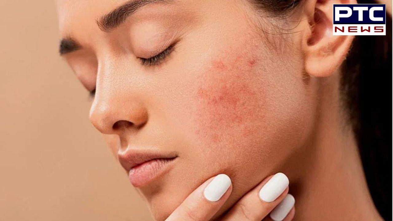 Pimple During Periods : ਮਾਹਵਾਰੀ ਦੌਰਾਨ ਕਿਉਂ ਹੁੰਦੇ ਹਨ ਮੁਹਾਸੇ ? ਜਾਣੋ ਇਨ੍ਹਾਂ 'ਤੋਂ ਬਚਣ ਦੇ ਤਰੀਕੇ