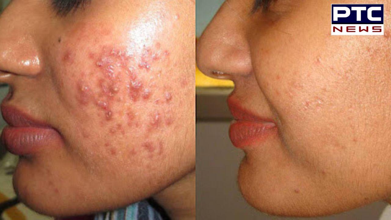 Acne And Pimple : ਮੁਹਾਸੇ ਤੇ ਫਿਣਸੀਆਂ 'ਚ ਕੀ ਹੁੰਦਾ ਹੈ ਫਰਕ, ਜਾਣੋ ਇਹਨਾਂ ਤੋਂ ਕਿਵੇਂ ਪਾਈਏ ਛੁਟਕਾਰਾ ? ਜਾਣੋ