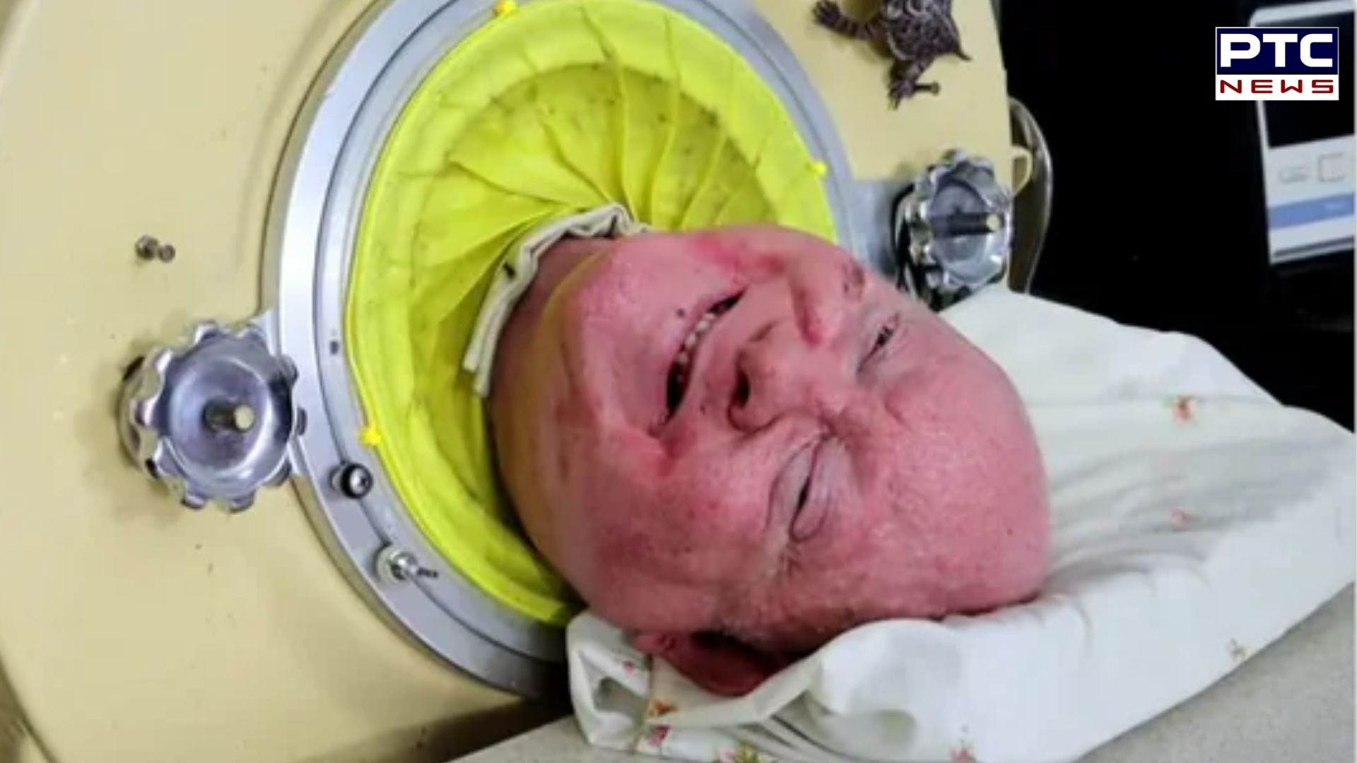 Polio Paul is no more: Paul Alexander who spent entire life in iron lung dies at 78