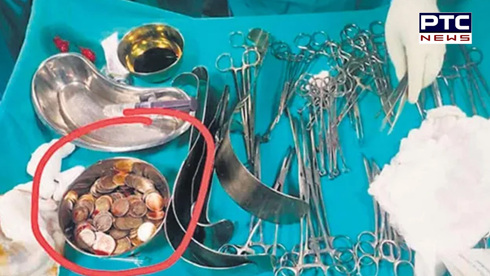 Man swallows 39 coins, 37 magnets which helped him in body-building