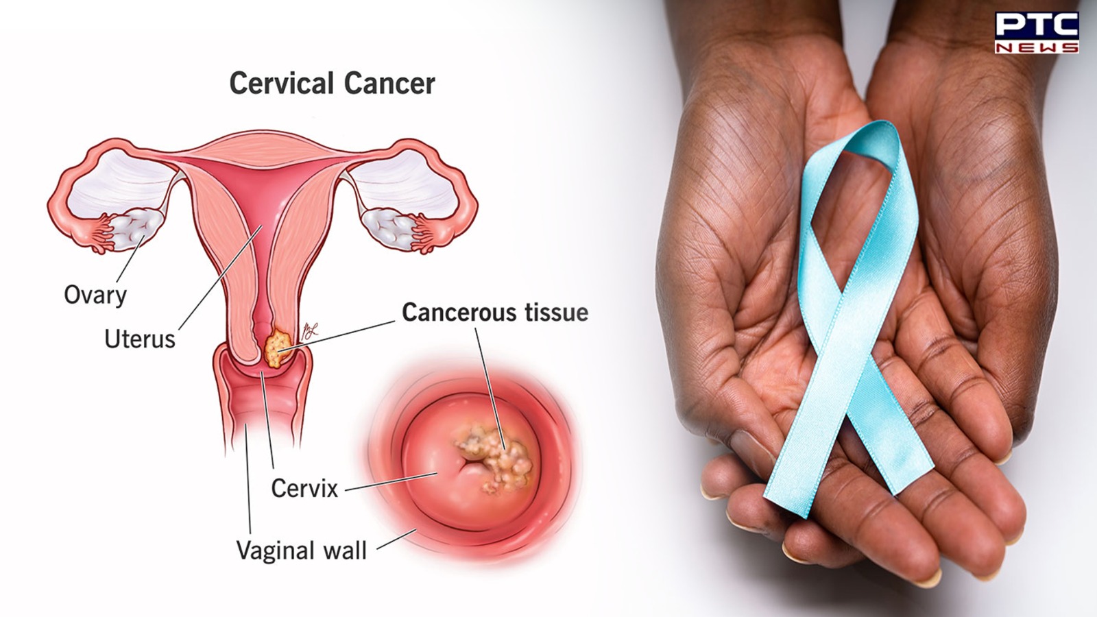 Is cervical cancer dangerous? This is what experts explain