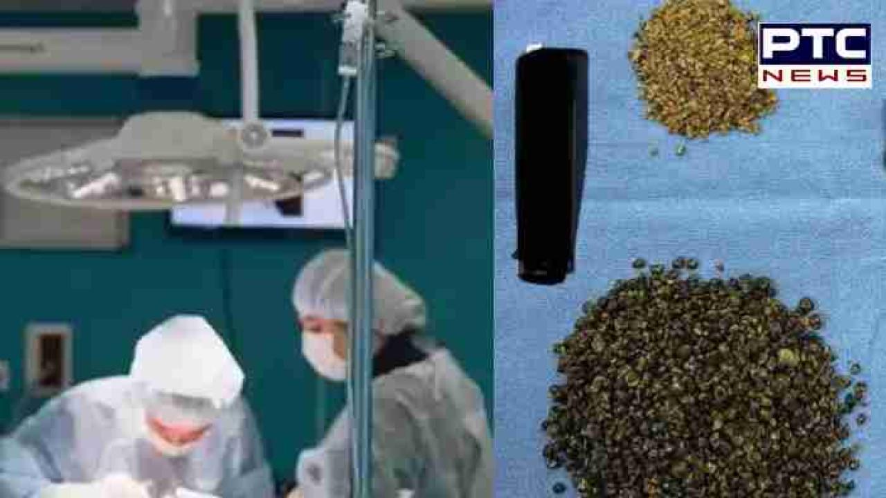 Doctors remove 8,125 gallstones : ਇੱਕ ਬਜ਼ੁਰਗ ਦੇ ਪੇਟ 'ਚੋਂ ਕੱਢੀਆਂ ਗਈਆਂ 8000 ਤੋਂ ਵੱਧ ਪੱਥਰੀਆਂ, 6 ਘੰਟੇ ਤੱਕ ਗਿਣਦੇ ਰਹੇ ਡਾਕਟਰ