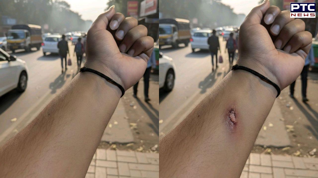 Employee creates fake injury with Google's Nano Banana tool, HR approves paid leave; internet reacts