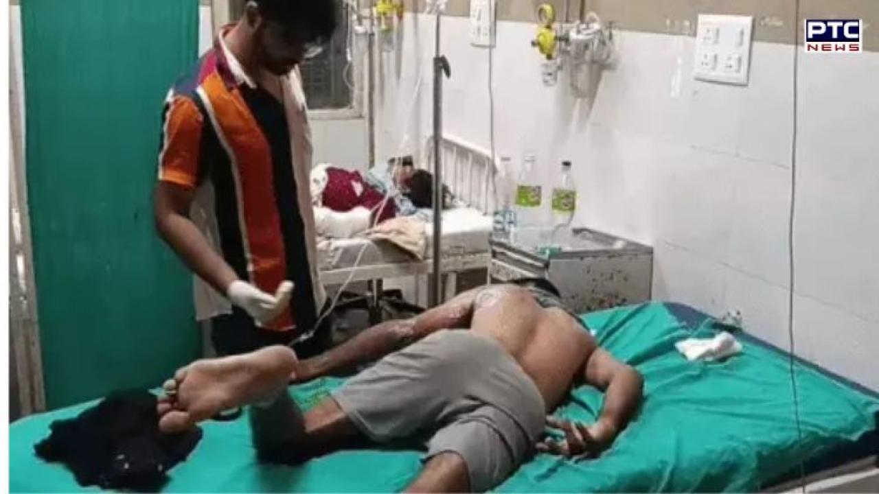 Amritsar: Woman calls ex-boyfriend to home, sets him afire with help of cousin;  accused also sustain burn injuries