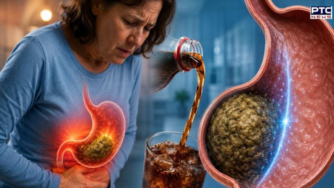 Diet Coke fixed a woman's stomach blockage caused by weight-loss drug, says a case report